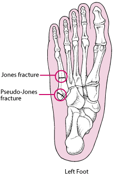 Jones and Pseudo-Jones Fractures