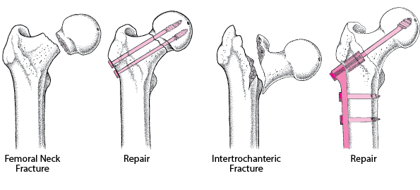 Repairing a Fractured Hip