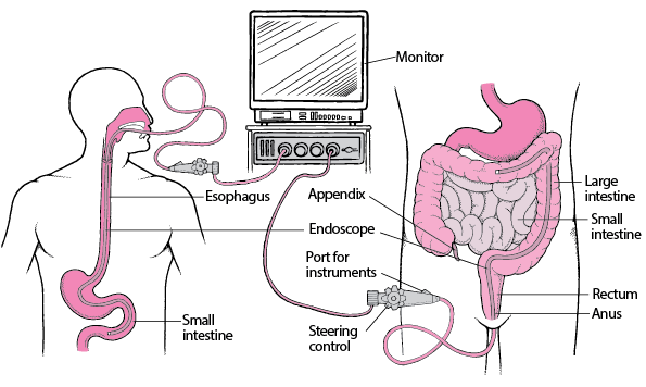 Viewing the Digestive Tract with an Endoscope