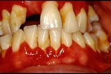 Gingivitis due to an impacted tooth (pericoronitis)