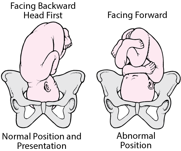 cephalic presentation spine towards maternal left