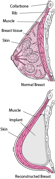 Rebuilding a Breast