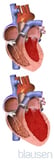 Overview of Cardiomyopathy