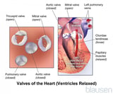 Overview of Heart Valve Disorders