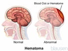 Intracranial Hematomas