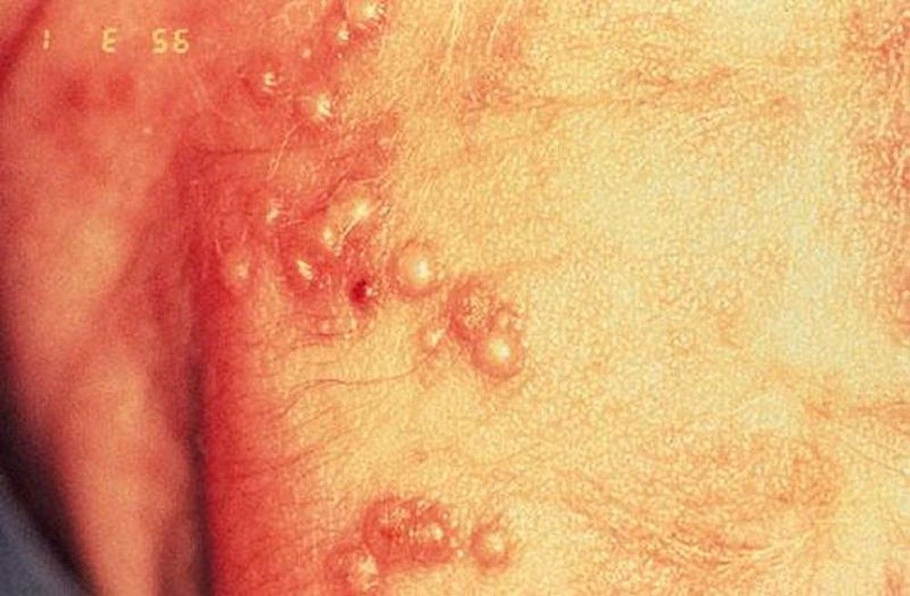 Bumps vs herpes