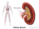 Stones in the Urinary Tract
