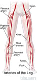 Overview of Peripheral Arterial Disease