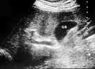 Ultrasound Scanning (Ultrasonography) of the Abdomen