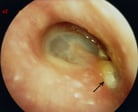 Chronic Middle Ear Infection in Children