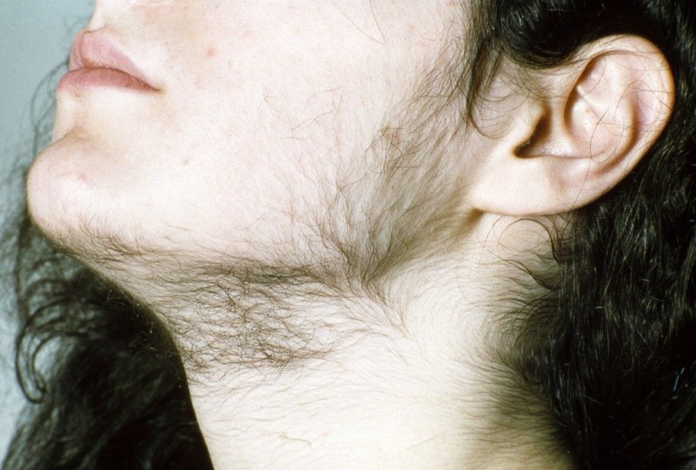 Hairiness - Skin Disorders - Merck Manuals Consumer Version