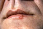 Lip Sores, Lip Inflammation, and Other Changes