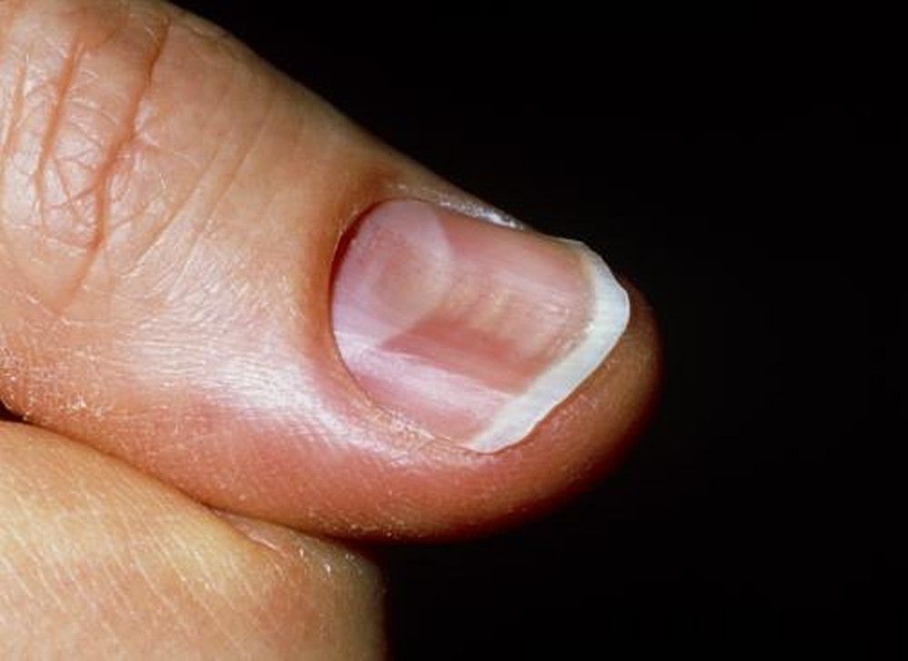 Deformities, Dystrophies, and Discoloration of the Nails - Skin Disorders -  Merck Manuals Consumer Version