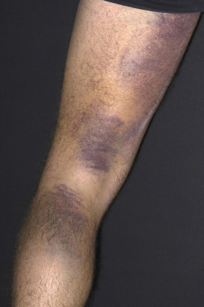 Old age bruises
