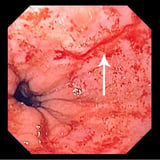 Esophageal Laceration (Mallory-Weiss Syndrome)