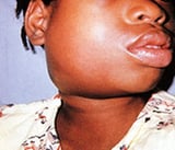 Complications of mumps