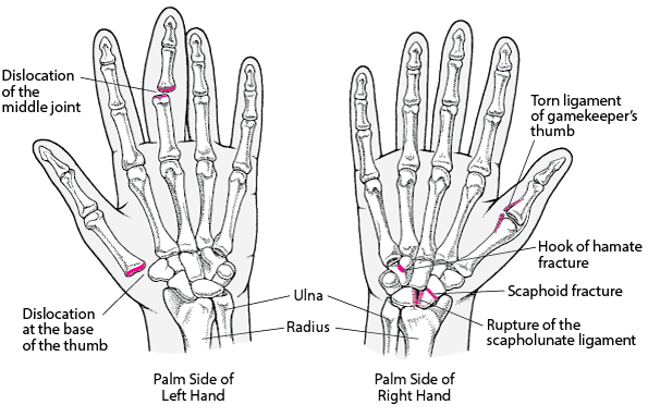 Common Hand Injuries