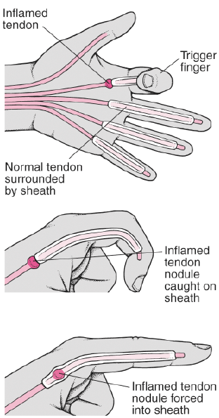 Trigger Finger Position