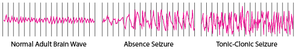 Brain Activity During a Seizure