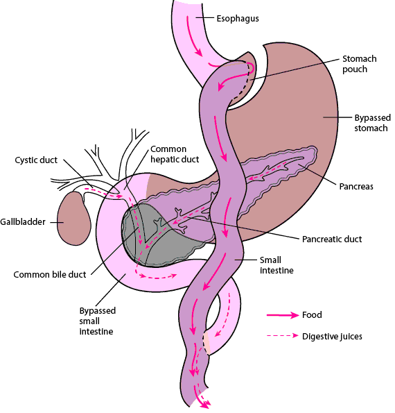 Bypassing Part of the Digestive Tract