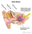 Acute Middle Ear Infection in Children