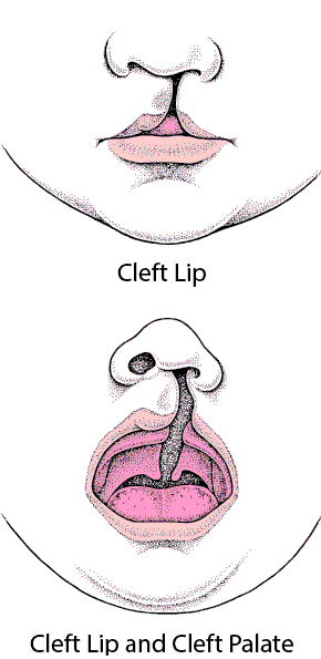 Cleft Lip and Cleft Palate: Defects of the Face