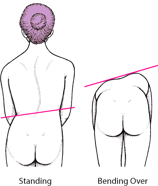 Scoliosis: A Curved Spine