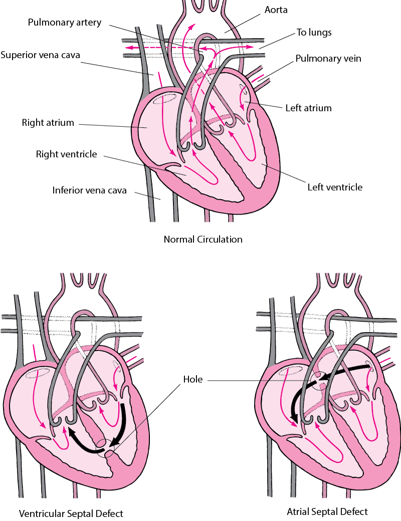 Septal Defect: A Hole in the Heart's Wall
