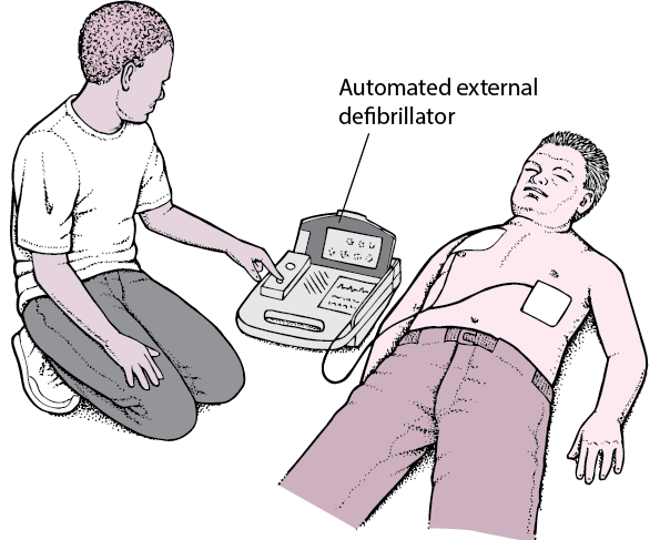 Automated External Defibrillator: Jump-Starting the Heart