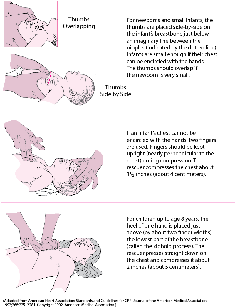 Doing Chest Compressions in an Infant