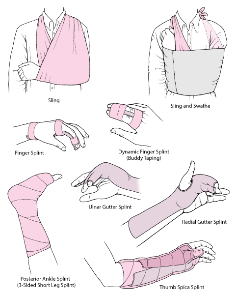 Commonly Used Techniques for Immobilizing a Joint