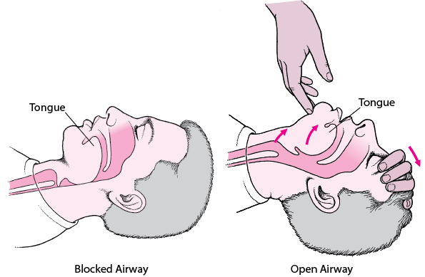 Opening an Airway in an Adult or Child