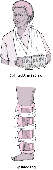 Commonly Used Splints