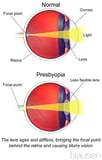 Overview of Refractive Disorders