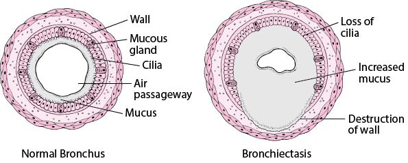 Understanding Bronchiectasis