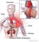 Thoracic Aortic Aneurysms