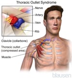 Thoracic Outlet Syndromes (TOS)