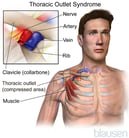 Thoracic Outlet Syndromes (TOS)