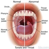Tonsillar Abscess
