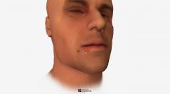 Ulcerations Buccales Et Inflammation De La Bouche Troubles Bucco Dentaires Manuels Msd Pour Le Grand Public