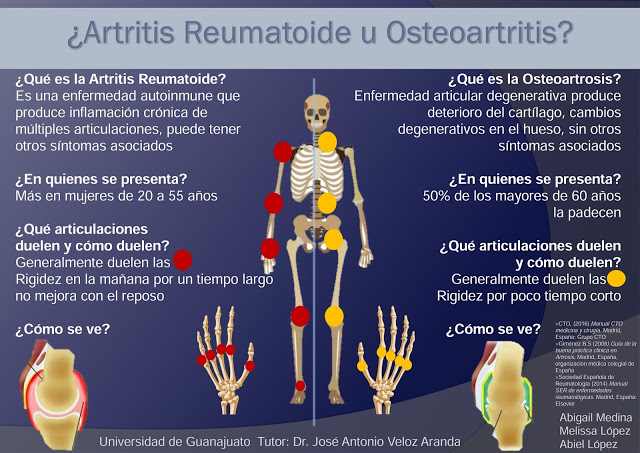 Infographic: ¿Artritis Reumatoide u Osteoartritis? - Manuale Merck