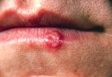 Mucocutaneous herpes simplex infection