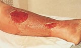 MRSA and purulent or complicated cellulitis