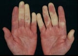 Mixed Connective Tissue Disease (MCTD)