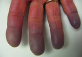 Causes of Secondary Raynaud Syndrome