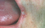 Cheilitis (lip inflammation)