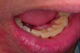 Tooth-Whitening Procedures