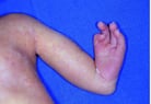 Congenital Limb Abnormalities