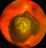 Cancers Affecting the Retina