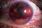 Uveitis Caused by Connective Tissue Disease